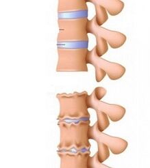 Stadien von Rampen der Osteochondrose des Halses