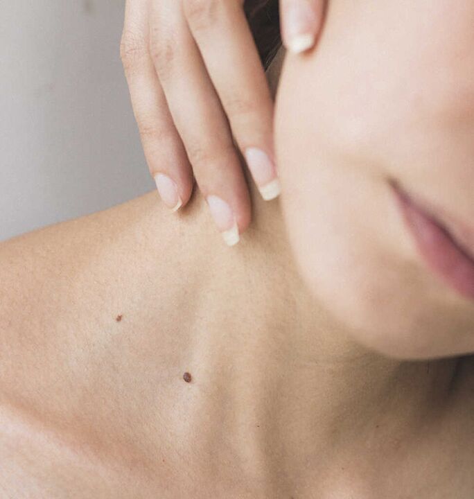 Steifheit im Nacken ist eines der Symptome im Anfangsstadium einer Osteochondrose der Halswirbelsäule