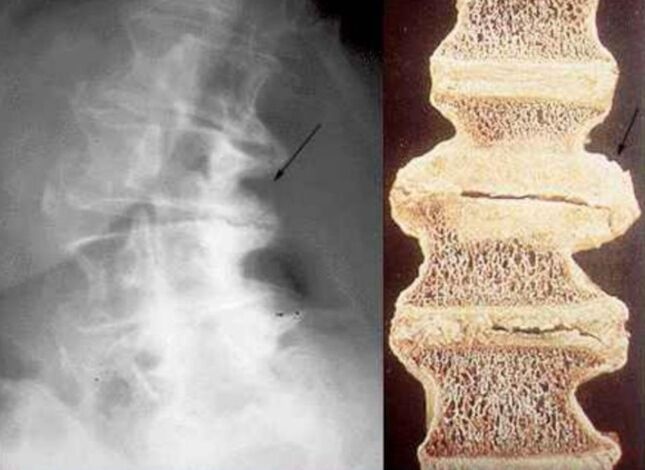 Schädigung der Wirbel bei thorakaler Osteochondrose