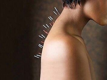 Die Reflextherapie ist eine wirksame Methode zur Behandlung der zervikalen Osteochondrose