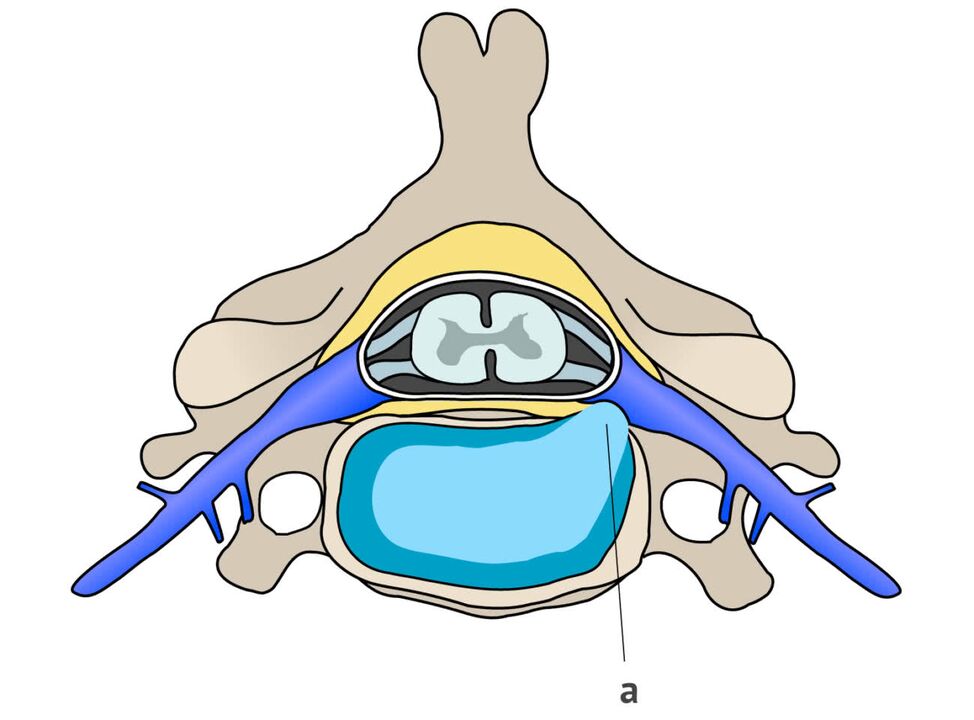 Zwischenwirbelhernie mit zervikaler Osteochondrose